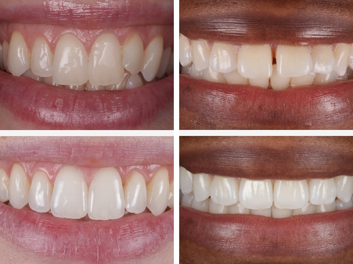 Comparison composite