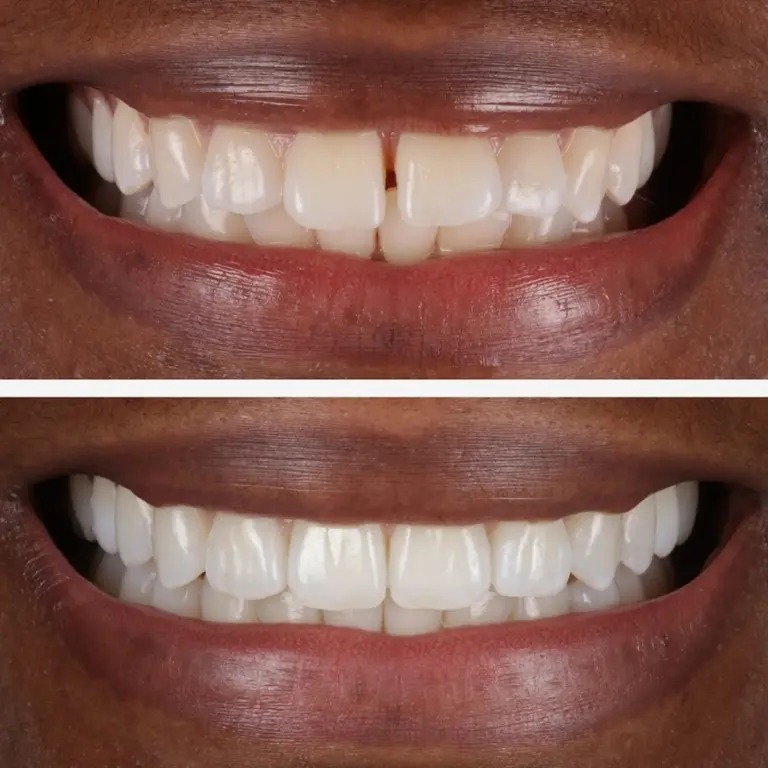 Invisalign 2 Copy