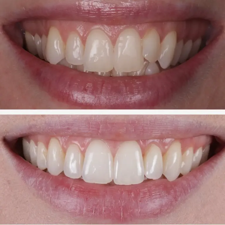 Invisalign 1 Copy