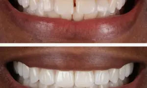 Invisalign 2