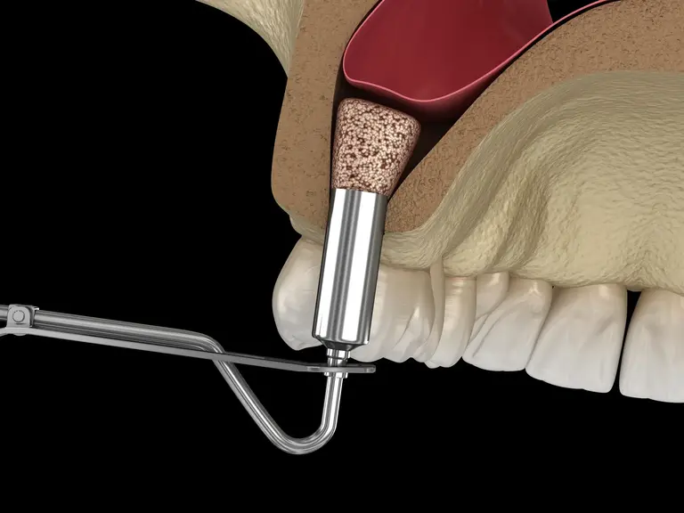 INTERNAL SINUS LIFT 2