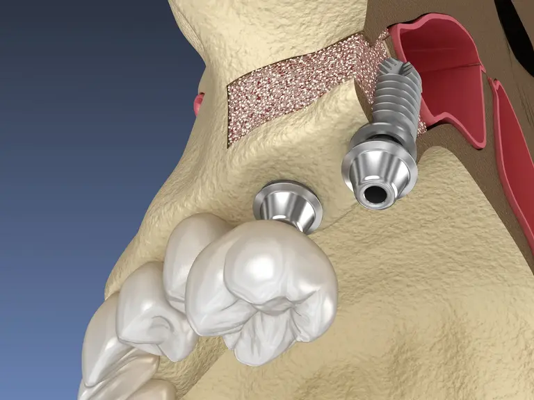LATERAL WINDOW SINUS 3
